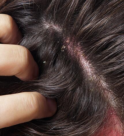 La dermite séborrhéique